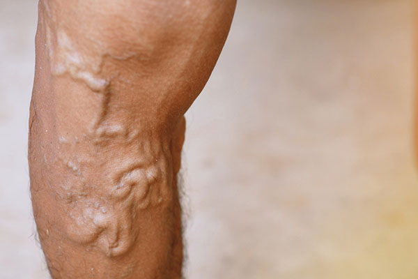 Vein Care